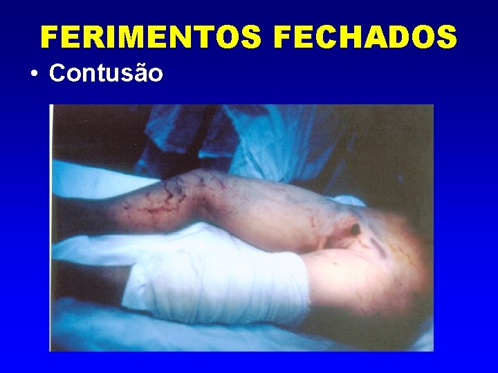 FERIMENTOS FECHADOS • Contusão 