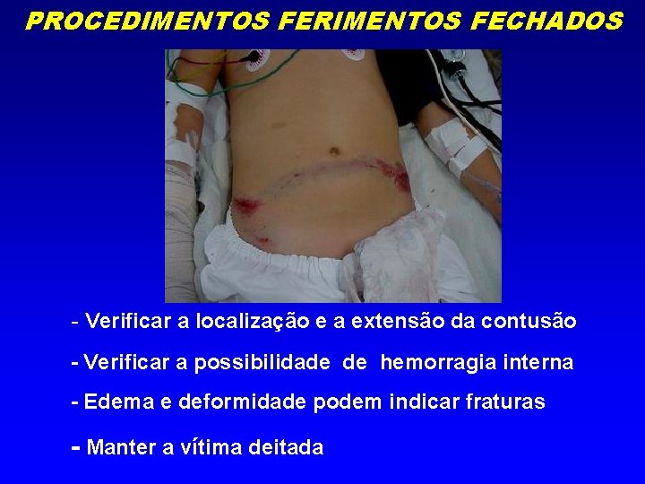 PROCEDIMENTOS FERIMENTOS FECHADOS - Verificar a localização e a extensão da contusão - Verificar