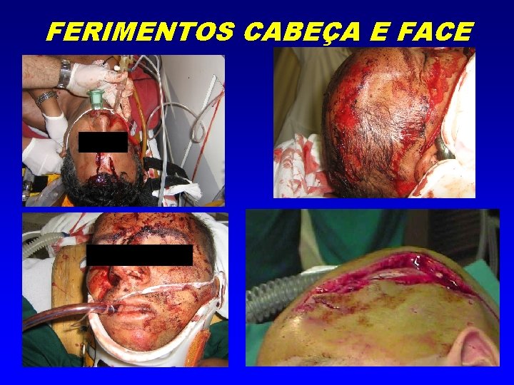 FERIMENTOS CABEÇA E FACE 