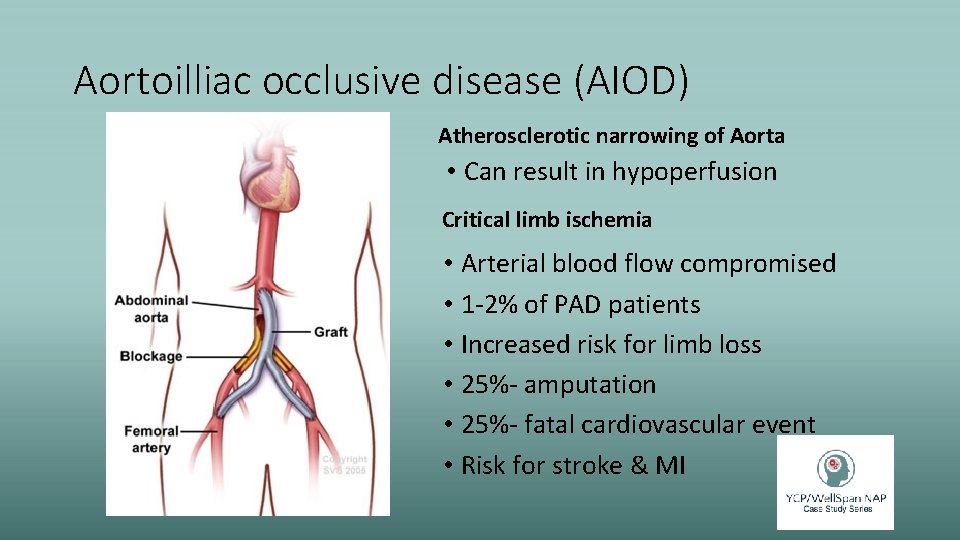 Aortoilliac occlusive disease (AIOD) Atherosclerotic narrowing of Aorta • Can result in hypoperfusion Critical
