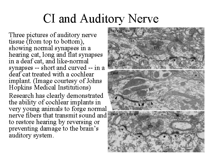 CI and Auditory Nerve Three pictures of auditory nerve tissue (from top to bottom),