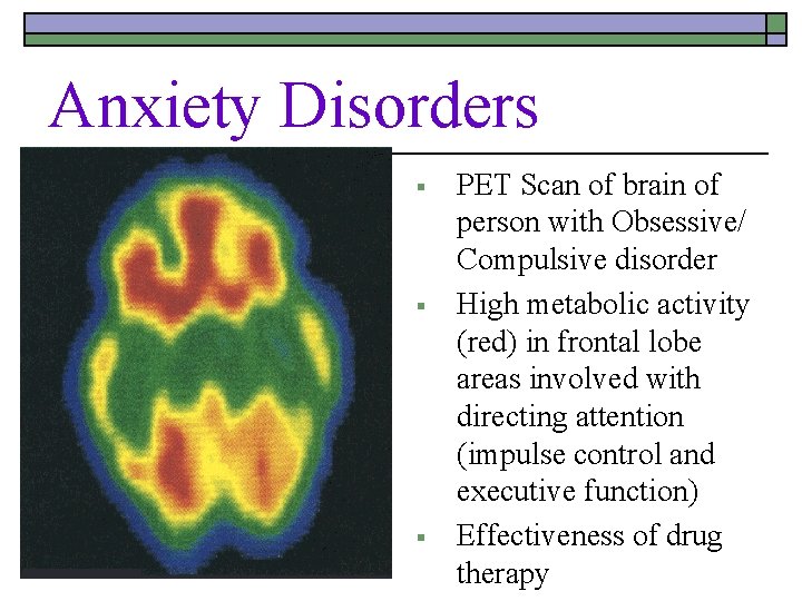 Anxiety Disorders § § § PET Scan of brain of person with Obsessive/ Compulsive