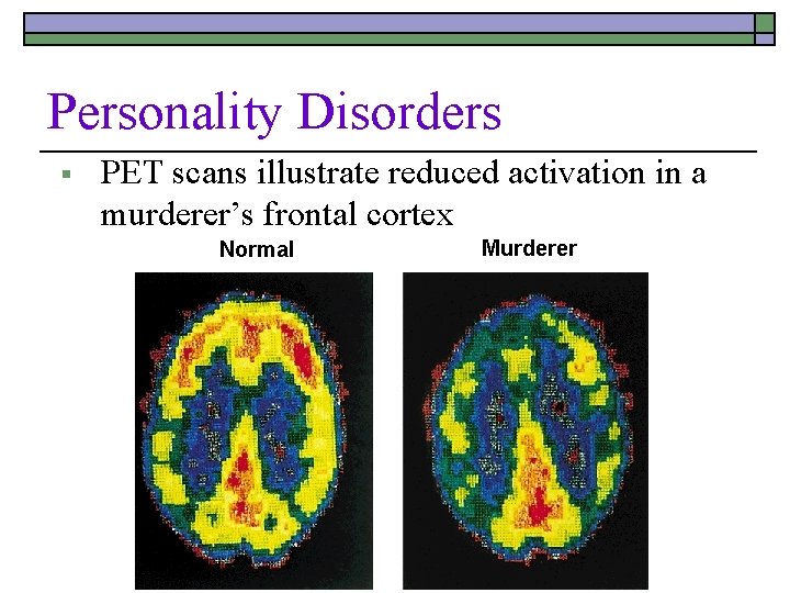 Personality Disorders § PET scans illustrate reduced activation in a murderer’s frontal cortex Normal