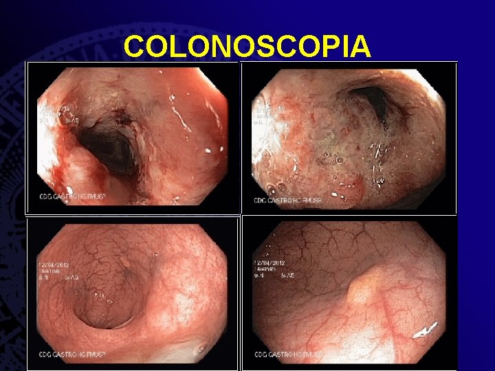 COLONOSCOPIA 