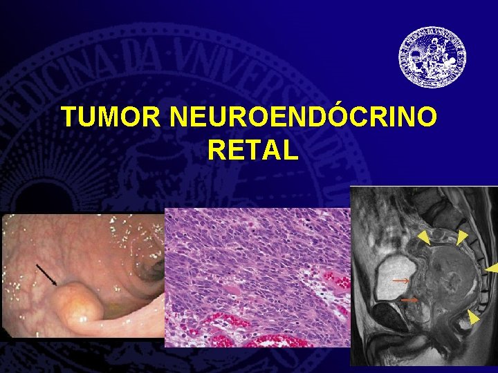 TUMOR NEUROENDÓCRINO RETAL 