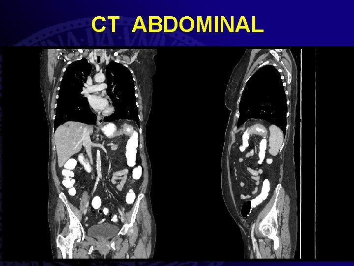 CT ABDOMINAL 