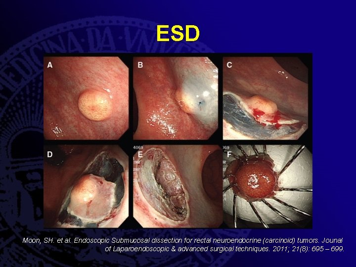 ESD Moon, SH. et al. Endoscopic Submucosal dissection for rectal neuroendocrine (carcinoid) tumors. Jounal