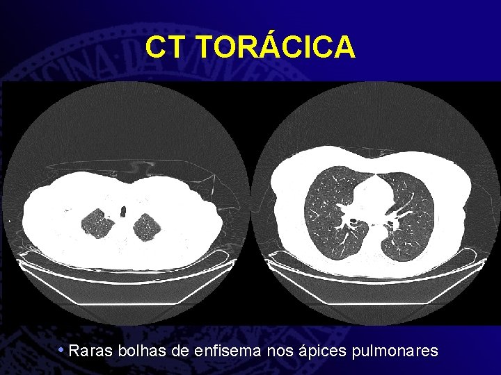 CT TORÁCICA • Raras bolhas de enfisema nos ápices pulmonares 