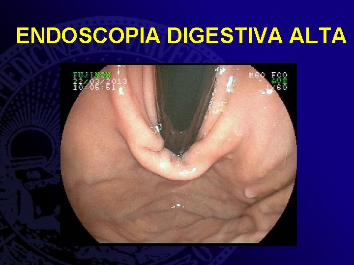 ENDOSCOPIA DIGESTIVA ALTA 