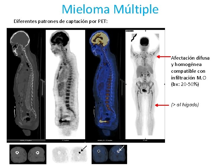 Mieloma Múltiple Diferentes patrones de captación por PET: Afectación difusa y homogénea compatible con