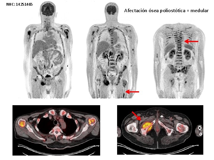 NHC: 14251465 Afectación ósea poliostótica + medular 