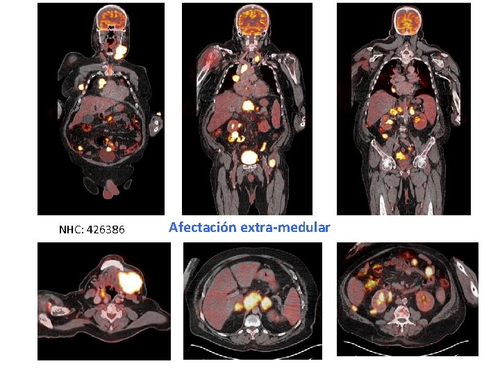 NHC: 426386 Afectación extra-medular 