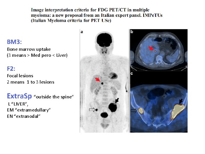 BM 3: Bone marrow uptake (3 means > Med pero < Liver) F 2: