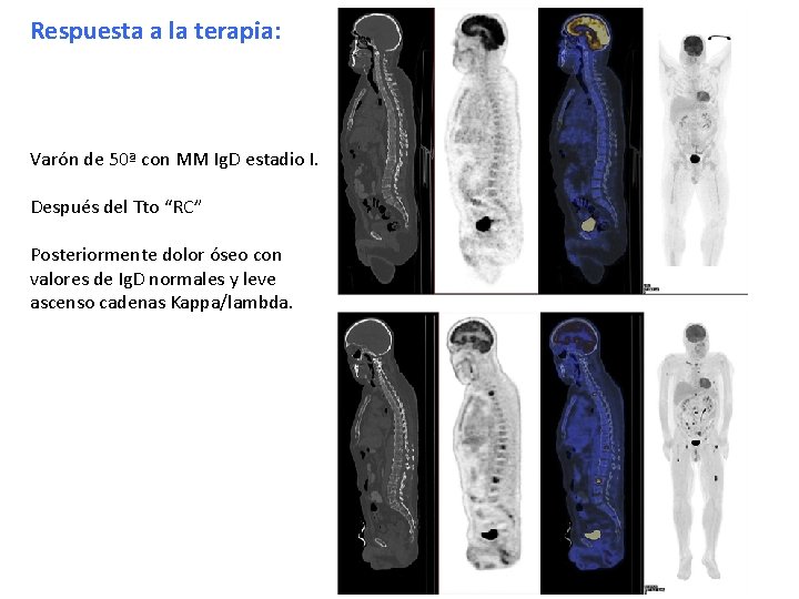 Respuesta a la terapia: Varón de 50ª con MM Ig. D estadio I. Después