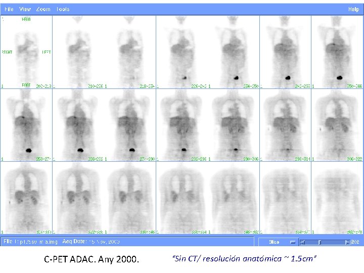 C-PET ADAC. Any 2000. “Sin CT/ resolución anatómica ~ 1. 5 cm” 