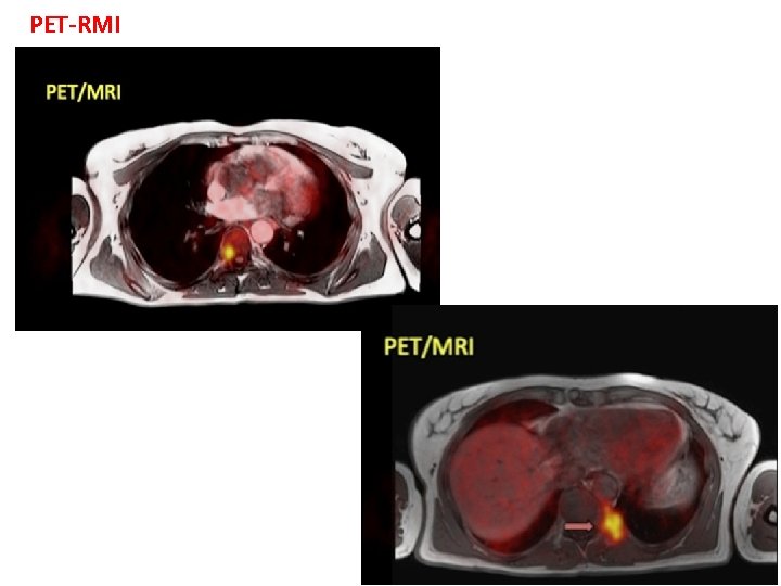 PET-RMI 