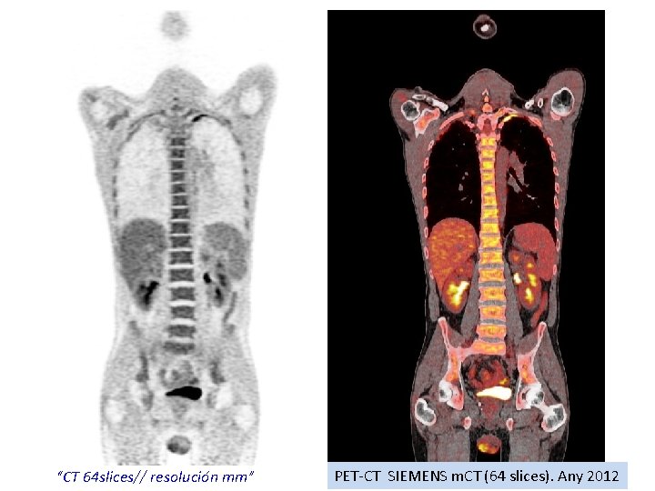 “CT 64 slices// resolución mm” PET-CT SIEMENS m. CT (64 slices). Any 2012 