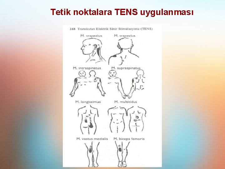 Tetik noktalara TENS uygulanması Tetik noktalara TENS uygulanması