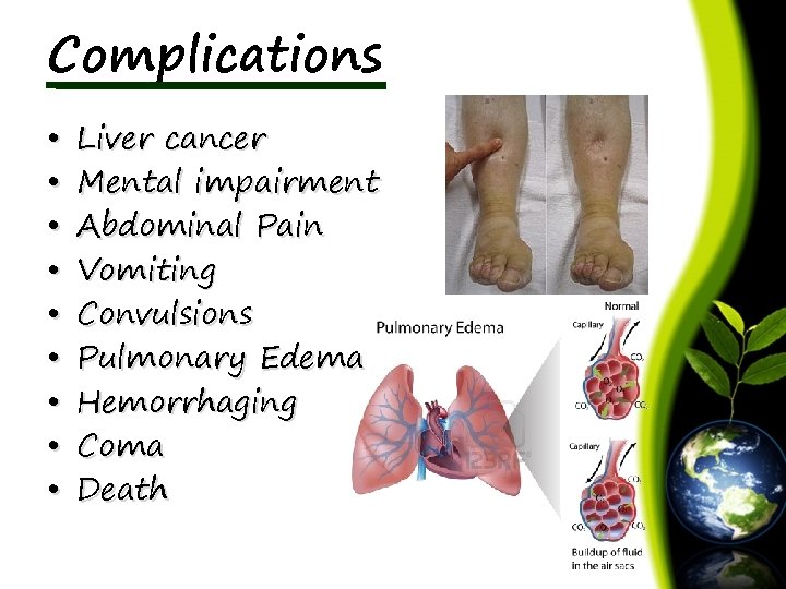 Complications • • • Liver cancer Mental impairment Abdominal Pain Vomiting Convulsions Pulmonary Edema