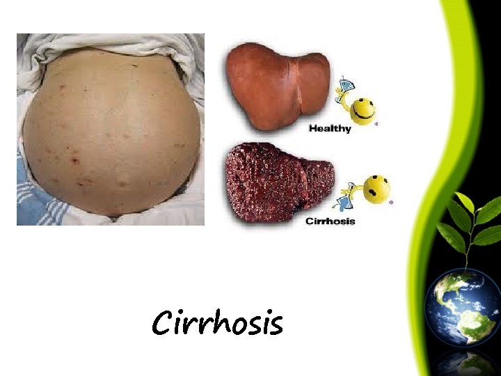 Cirrhosis 
