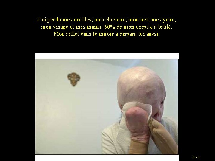 J’ai perdu mes oreilles, mes cheveux, mon nez, mes yeux, mon visage et mes