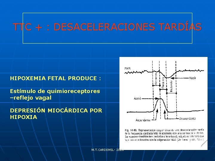 TTC + : DESACELERACIONES TARDÍAS HIPOXEMIA FETAL PRODUCE : Estímulo de quimioreceptores –reflejo vagal