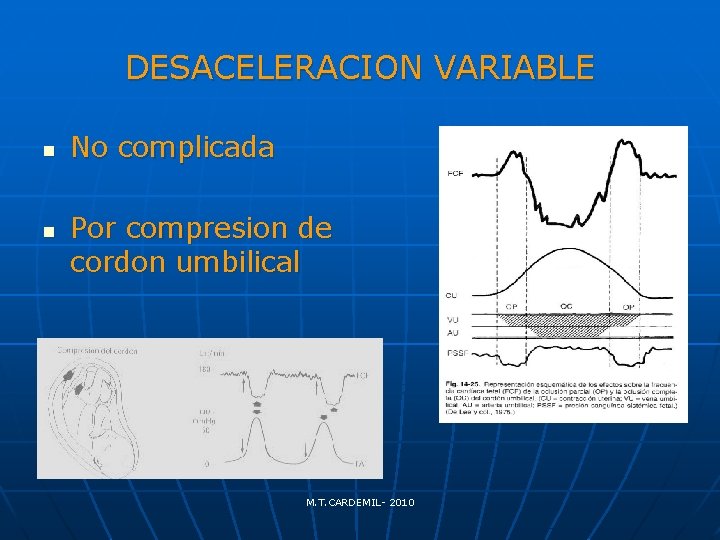 DESACELERACION VARIABLE n n No complicada Por compresion de cordon umbilical M. T. CARDEMIL-