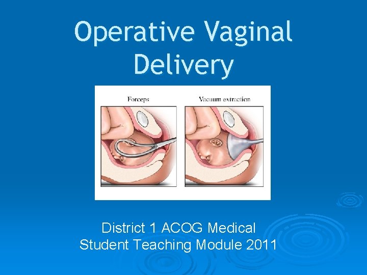 Operative Vaginal Delivery District 1 ACOG Medical Student Teaching Module 2011 