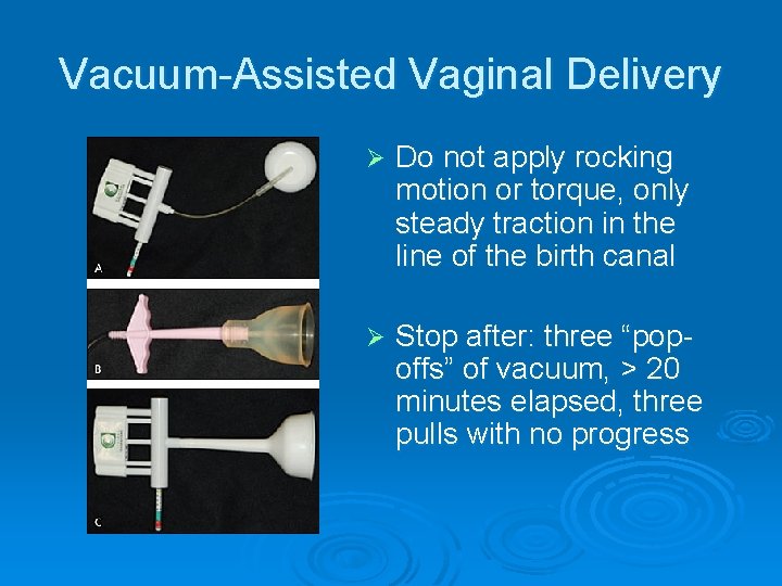 Vacuum-Assisted Vaginal Delivery Ø Do not apply rocking motion or torque, only steady traction