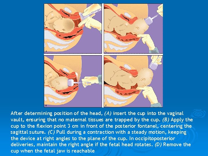 After determining position of the head, (A) insert the cup into the vaginal vault,