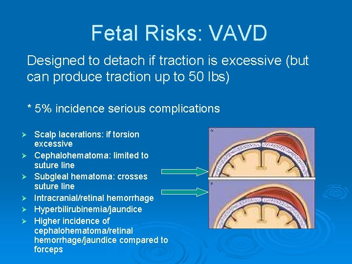 Fetal Risks: VAVD Designed to detach if traction is excessive (but can produce traction