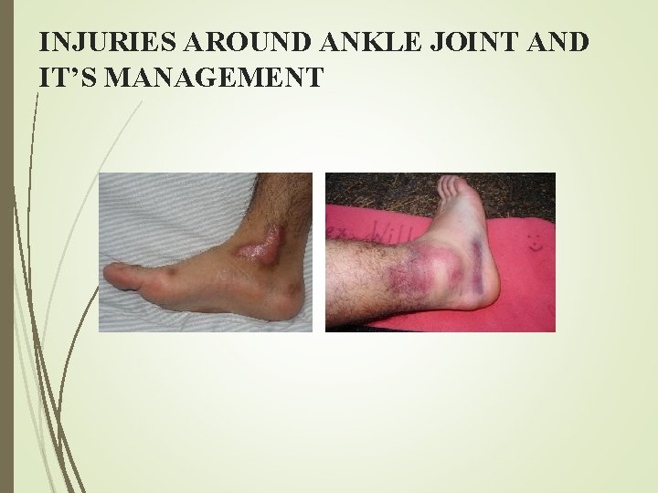 INJURIES AROUND ANKLE JOINT AND IT’S MANAGEMENT 