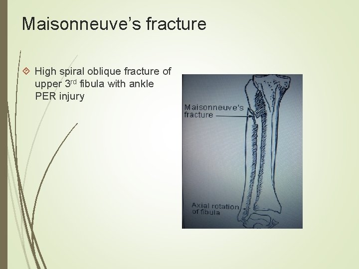 Maisonneuve’s fracture High spiral oblique fracture of upper 3 rd fibula with ankle PER