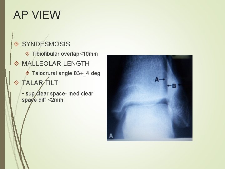 AP VIEW SYNDESMOSIS Tibiofibular overlap<10 mm MALLEOLAR LENGTH Talocrural angle 83+_4 deg TALAR TILT