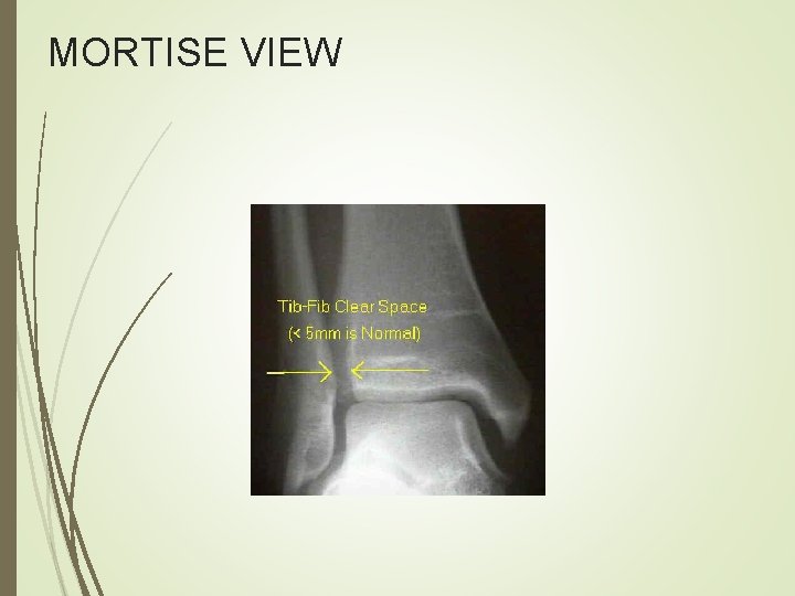 MORTISE VIEW 