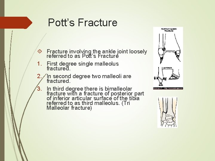 Pott’s Fracture involving the ankle joint loosely referred to as Pott’s Fracture 1. First