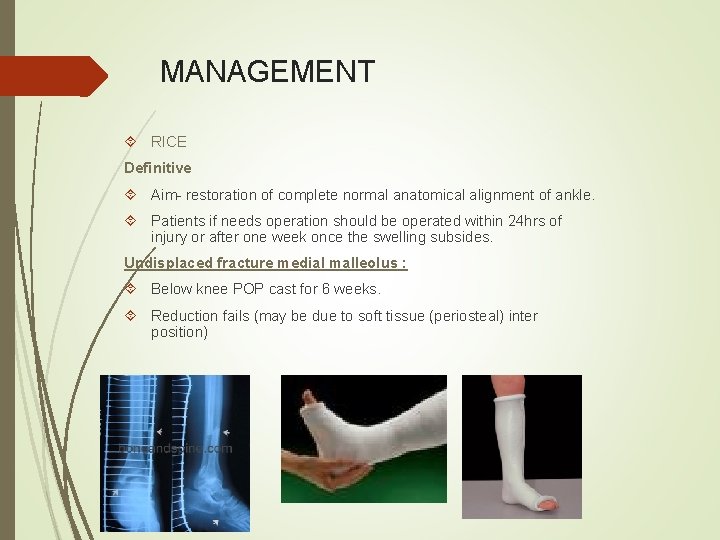 MANAGEMENT RICE Definitive Aim- restoration of complete normal anatomical alignment of ankle. Patients if