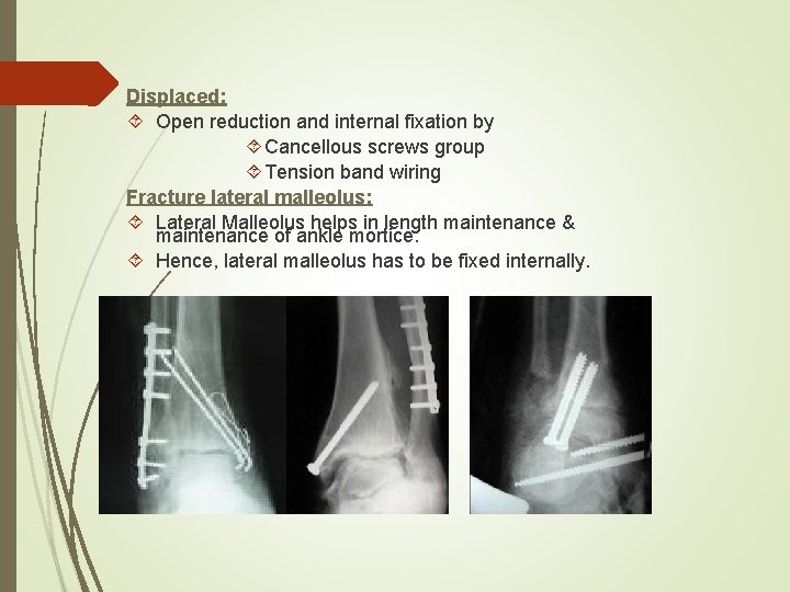 Displaced: Open reduction and internal fixation by Cancellous screws group Tension band wiring Fracture