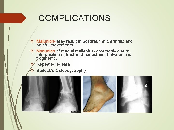 COMPLICATIONS Malunion- may result in posttraumatic arthritis and painful movements. Nonunion of medial malleolus-