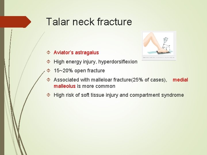 Talar neck fracture Aviator’s astragalus High energy injury, hyperdorsiflexion 15~20% open fracture Associated with