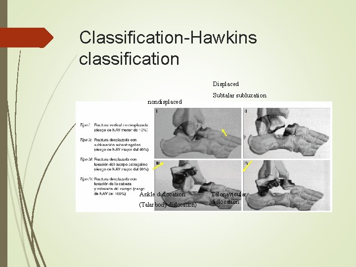 Classification-Hawkins classification Displaced nondisplaced Ankle dislocation (Talar body dislocation) Subtalar subluxation Talonavicular dislocation 