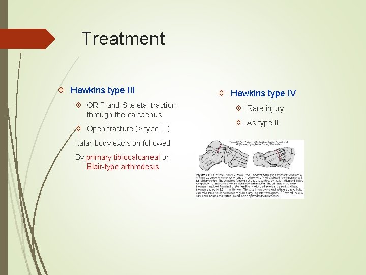 Treatment Hawkins type III ORIF and Skeletal traction through the calcaenus Open fracture (>