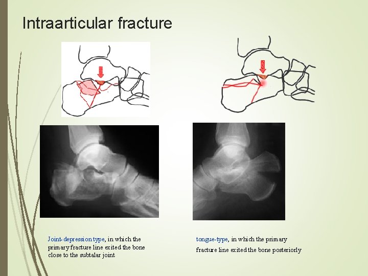 Intraarticular fracture Joint-depression type, in which the primary fracture line exited the bone close