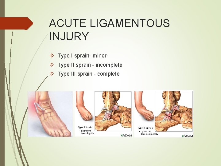 ACUTE LIGAMENTOUS INJURY Type I sprain- minor Type II sprain - incomplete Type III