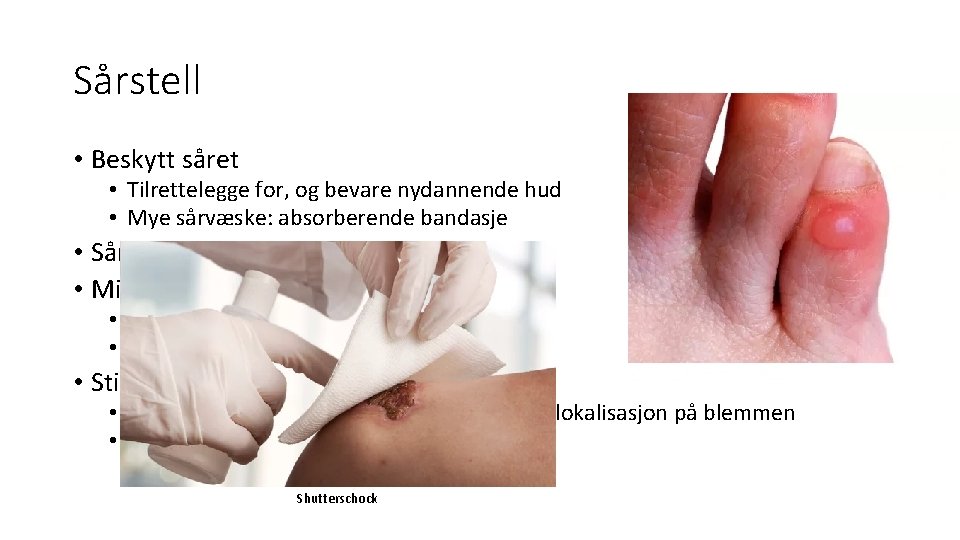 Sårstell • Beskytt såret • Tilrettelegge for, og bevare nydannende hud • Mye sårvæske: