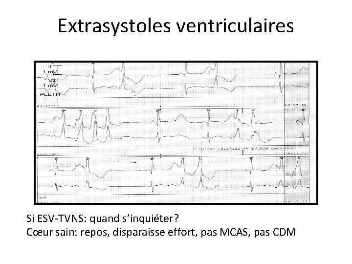 Extrasystoles ventriculaires Si ESV-TVNS: quand s’inquiéter? Cœur sain: repos, disparaisse effort, pas MCAS, pas