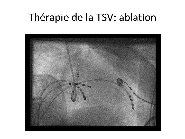 Thérapie de la TSV: ablation 