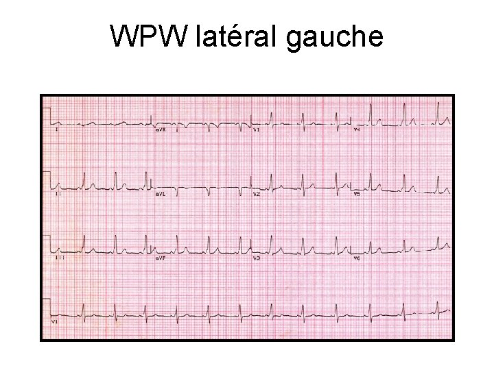 WPW latéral gauche 