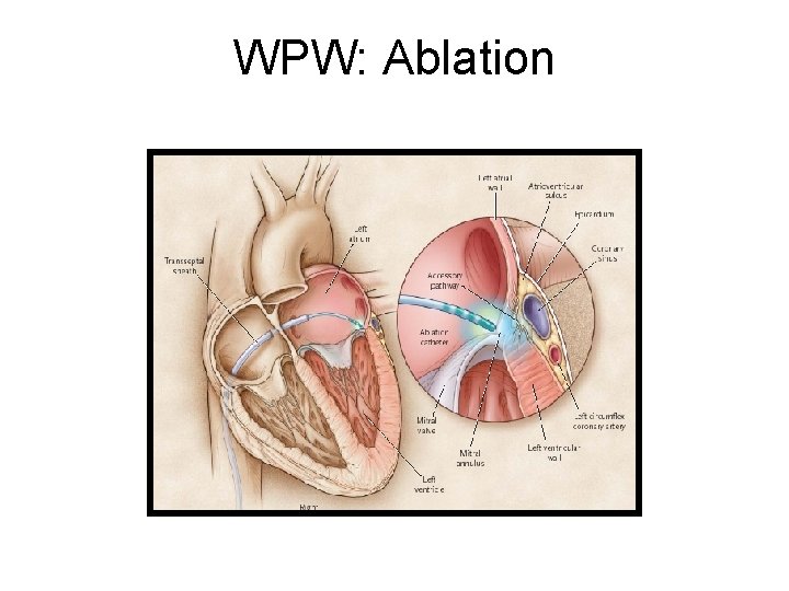 WPW: Ablation 