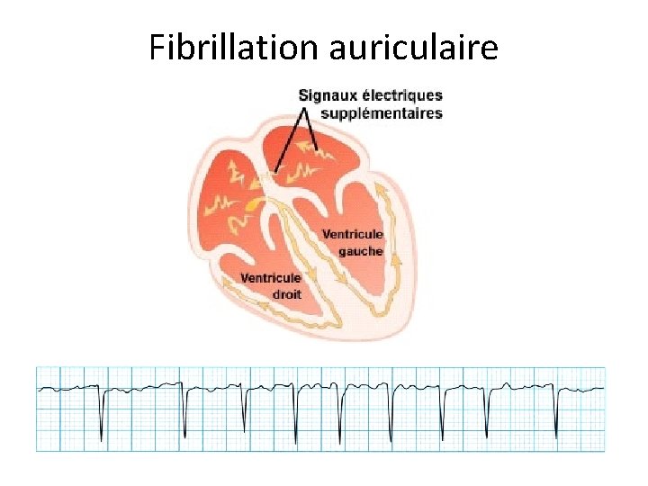 Fibrillation auriculaire 